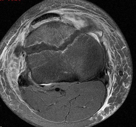 Figure 5 for case Salter type IV fracture ( RID4688 )